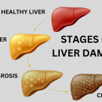 Can Fatty liver Cause Weight Gain