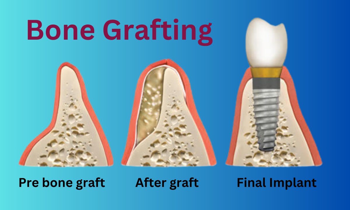 Dental Bone Graft Procedure