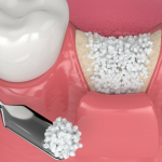 Dental Bone Graft Procedure