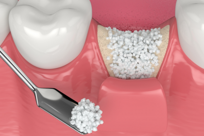 Dental Bone Graft Procedure