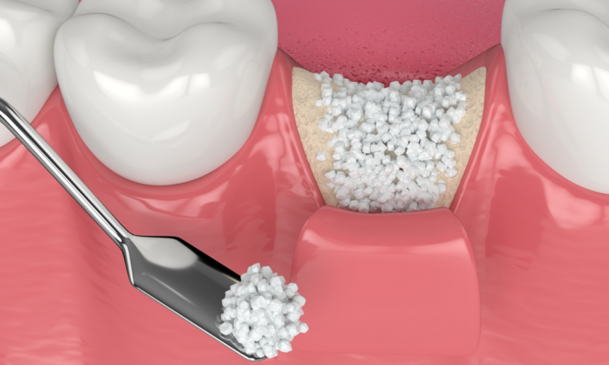 Dental Bone Graft Procedure