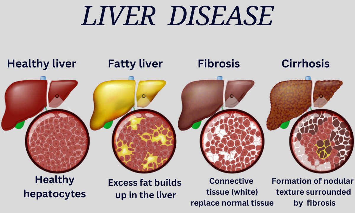 Can Fatty liver Cause Weight Gain