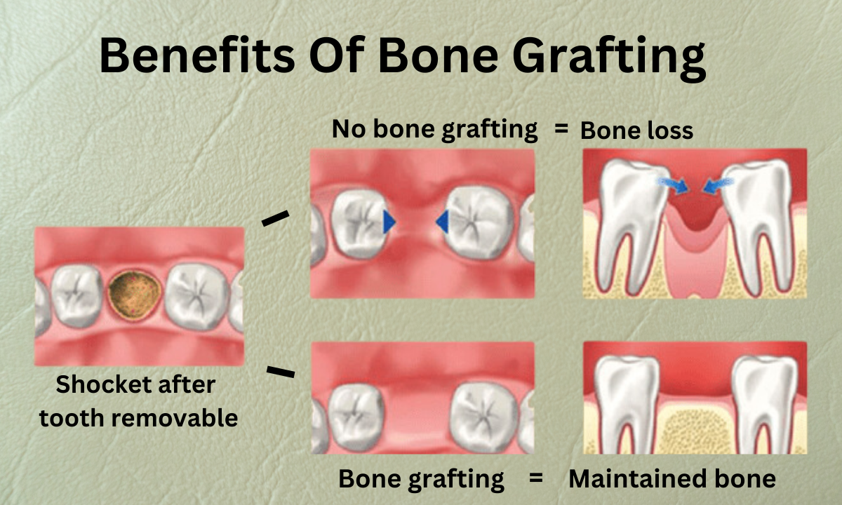 Dental Bone Graft Procedure