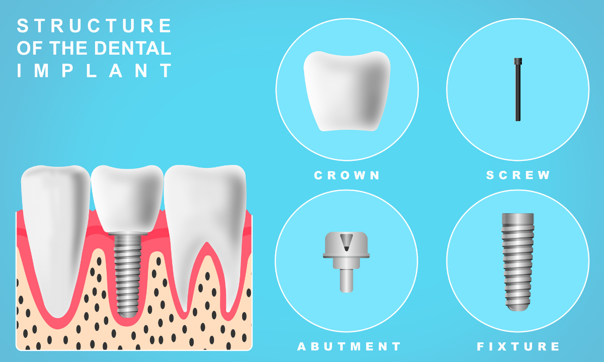 Dental Bone Graft Procedure