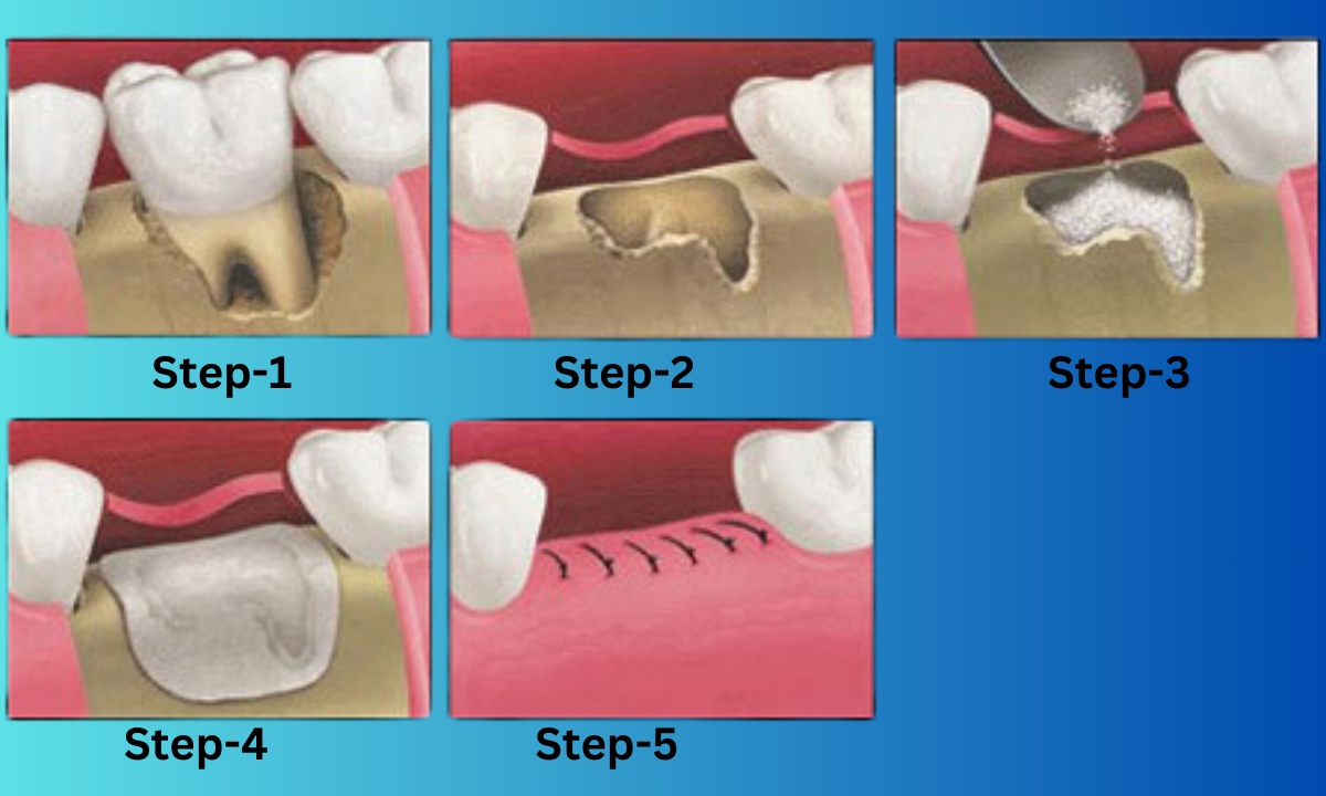 Dental Bone Graft Procedure