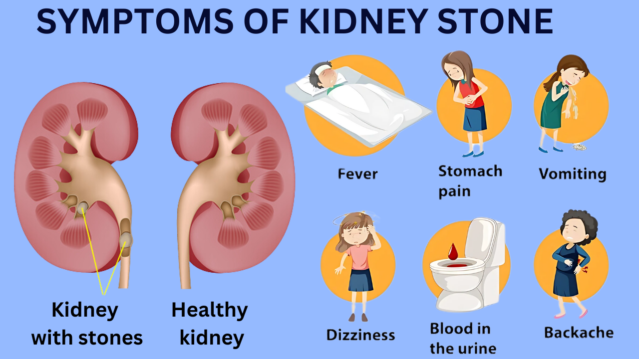 Beer For Kidney Stones