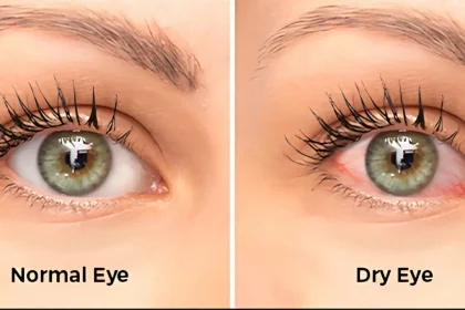 Dry Eyes With Contacts