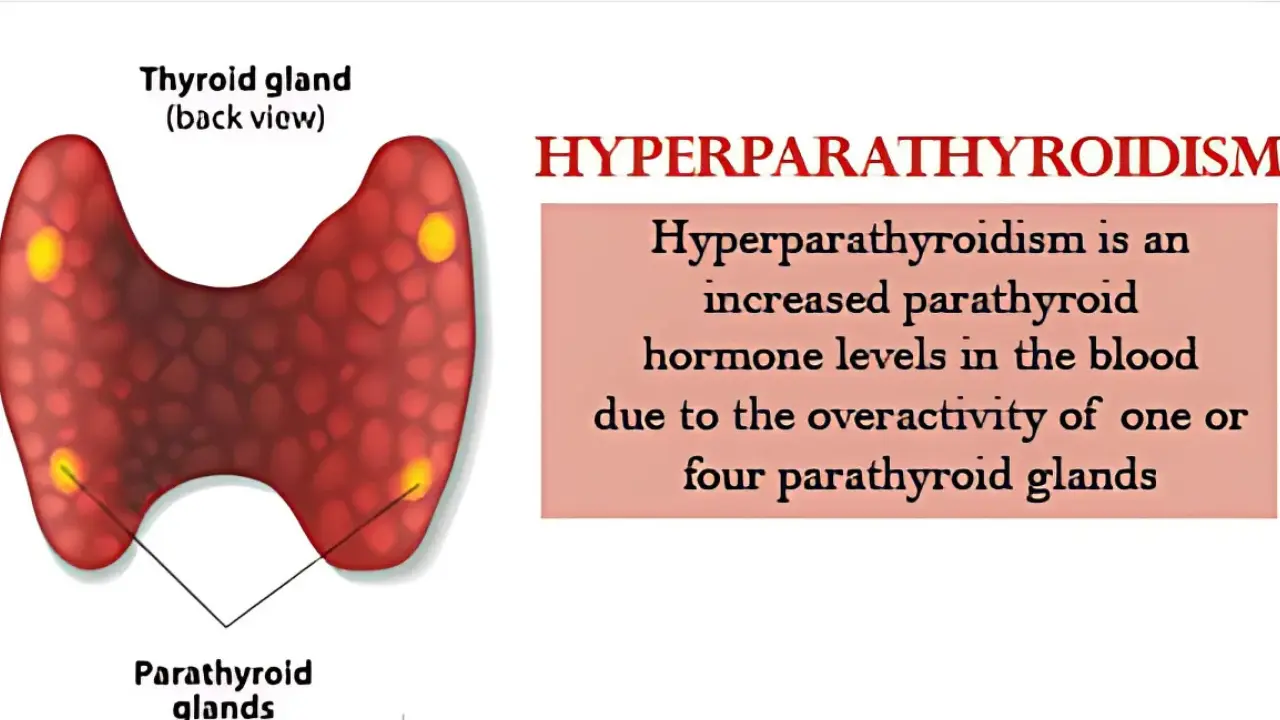 Hyperparathyroidism Eye Problems